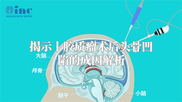 揭示丨胶质瘤术后头骨凹陷的成因解析