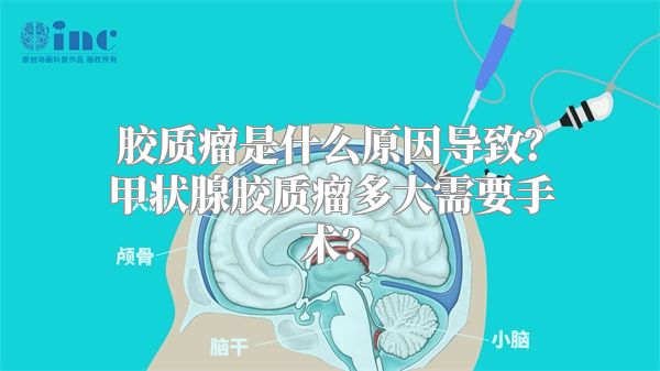 胶质瘤是什么原因导致？甲状腺胶质瘤多大需要手术？