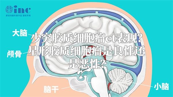 少突胶质细胞瘤ct表现？星形胶质细胞瘤是良性还是恶性？