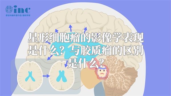 星形细胞瘤的影像学表现是什么？与胶质瘤的区别是什么？