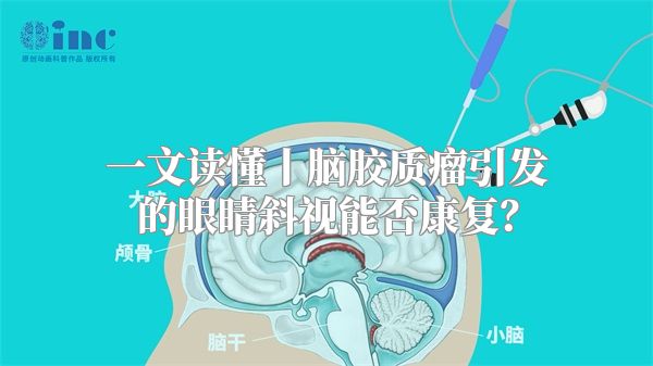 一文读懂丨脑胶质瘤引发的眼睛斜视能否康复？