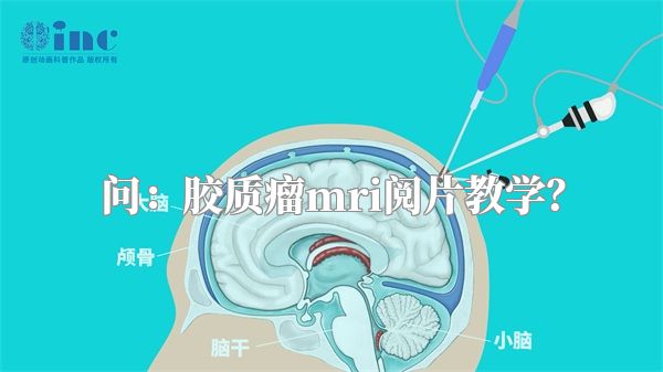 问：胶质瘤mri阅片教学？