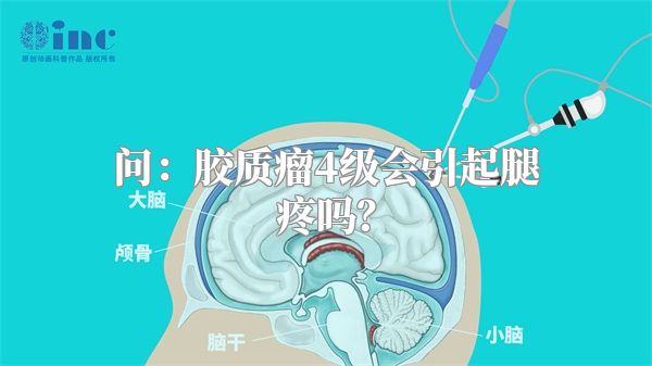 问：胶质瘤4级会引起腿疼吗？