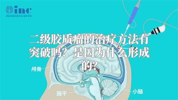 二级胶质瘤的治疗方法有突破吗？是因为什么形成的？