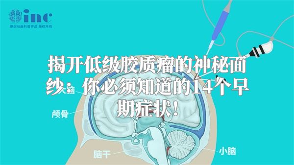 揭开低级胶质瘤的神秘面纱：你必须知道的14个早期症状！