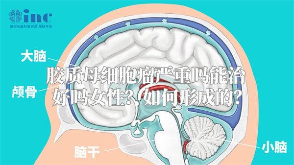 胶质母细胞瘤严重吗能治好吗女性？如何形成的？