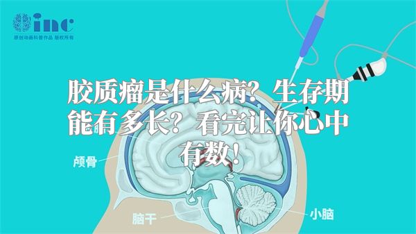 胶质瘤是什么病？生存期能有多长？看完让你心中有数！