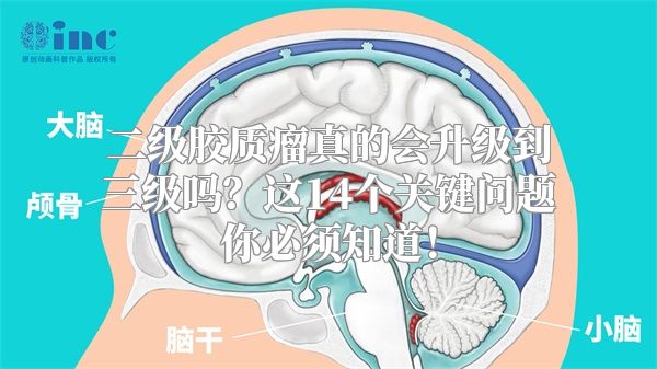 二级胶质瘤真的会升级到三级吗？这14个关键问题你必须知道！