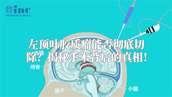 左顶叶胶质瘤能否彻底切除？揭秘手术背后的真相！