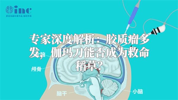 专家深度解析：胶质瘤多发，伽玛刀能否成为救命稻草？