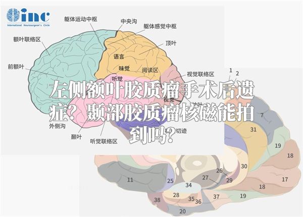 左侧额叶胶质瘤手术后遗症？颞部胶质瘤核磁能拍到吗？