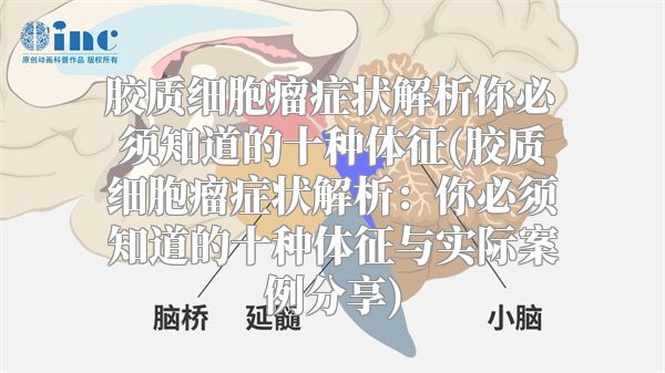 胶质细胞瘤症状解析你必须知道的十种体征(胶质细胞瘤症状解析：你必须知道的十种体征与实际案例分享)