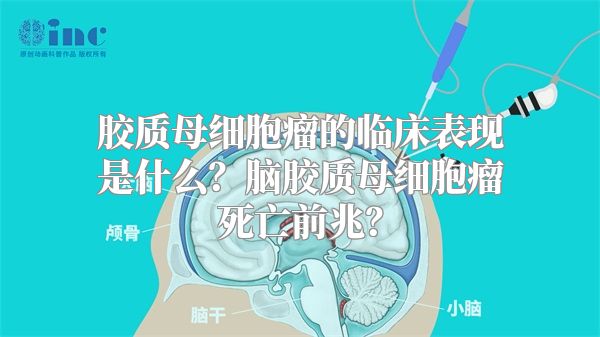 胶质母细胞瘤的临床表现是什么？脑胶质母细胞瘤死亡前兆？