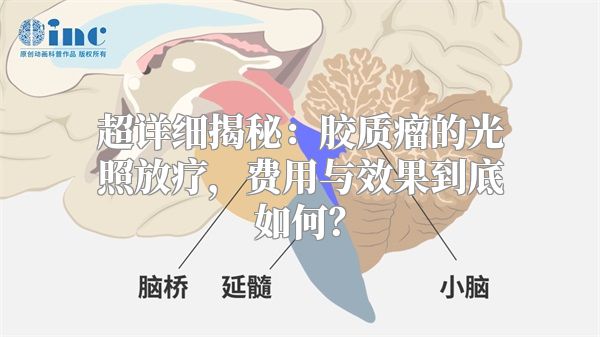 超详细揭秘：胶质瘤的光照放疗，费用与效果到底如何？