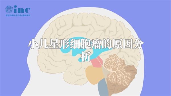 小儿星形细胞瘤的原因分析