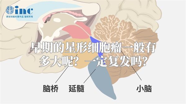 早期的星形细胞瘤一般有多大呢？一定复发吗？