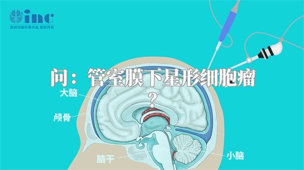 问：管室膜下星形细胞瘤？