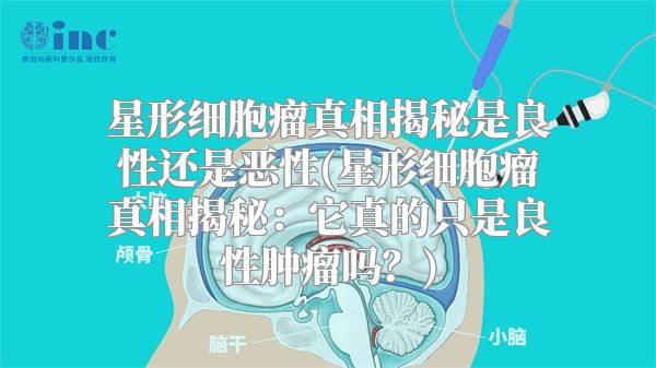 星形细胞瘤真相揭秘是良性还是恶性(星形细胞瘤真相揭秘：它真的只是良性肿瘤吗？)