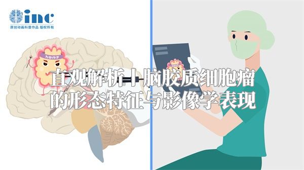 直观解析丨脑胶质细胞瘤的形态特征与影像学表现