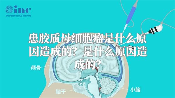 患胶质母细胞瘤是什么原因造成的？是什么原因造成的？