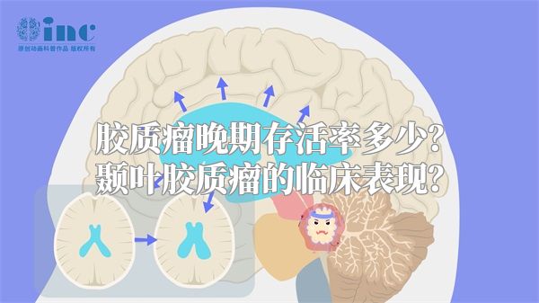 胶质瘤晚期存活率多少？颞叶胶质瘤的临床表现？