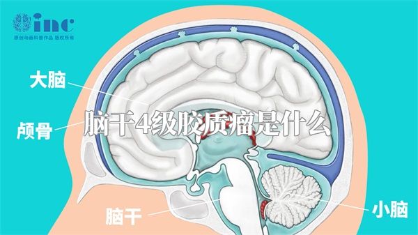 脑干4级胶质瘤是什么