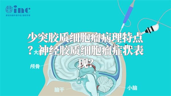 少突胶质细胞瘤病理特点？神经胶质细胞瘤症状表现？