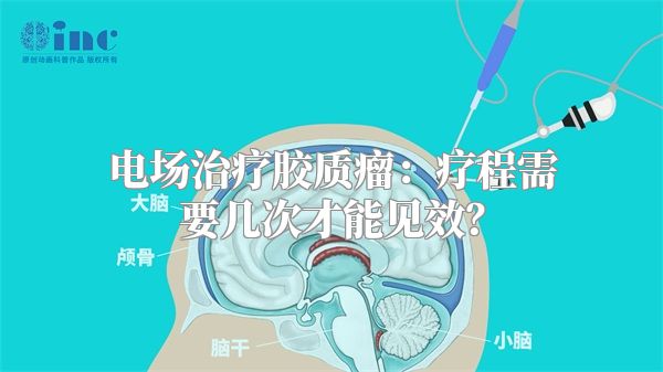 电场治疗胶质瘤：疗程需要几次才能见效？