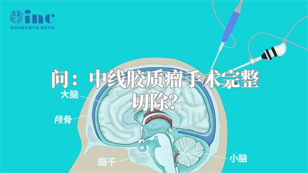 问：中线胶质瘤手术完整切除？