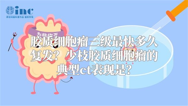 胶质细胞瘤三级最快多久复发？少枝胶质细胞瘤的典型ct表现是？