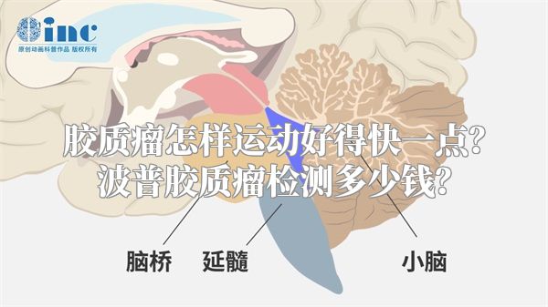 胶质瘤怎样运动好得快一点？波普胶质瘤检测多少钱？