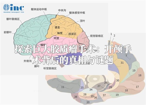 探索巨大胶质瘤手术：开颅手术背后的真相与谜题