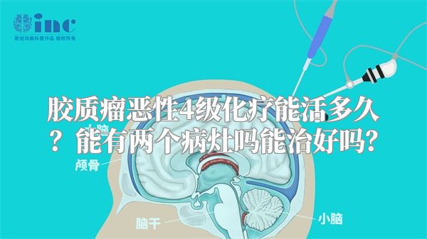 胶质瘤恶性4级化疗能活多久？能有两个病灶吗能治好吗？