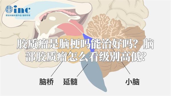 胶质瘤是脑梗吗能治好吗？脑部胶质瘤怎么看级别高低？