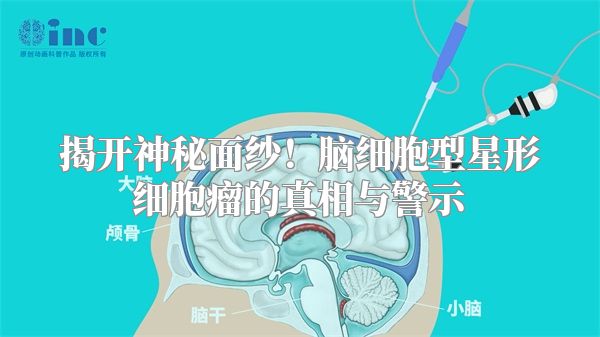 揭开神秘面纱！脑细胞型星形细胞瘤的真相与警示