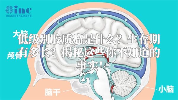 低级别胶质瘤是什么？生存期有多长？揭秘这些你不知道的事实！