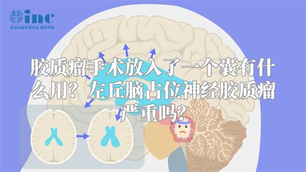 胶质瘤手术放入了一个囊有什么用？左丘脑占位神经胶质瘤严重吗？