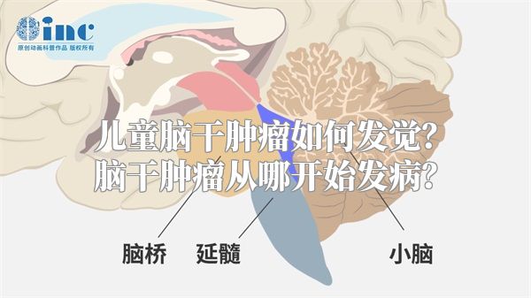 儿童脑干肿瘤如何发觉？脑干肿瘤从哪开始发病？