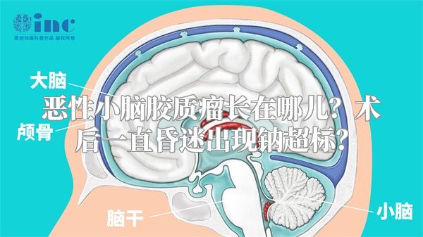 恶性小脑胶质瘤长在哪儿？术后一直昏迷出现钠超标？