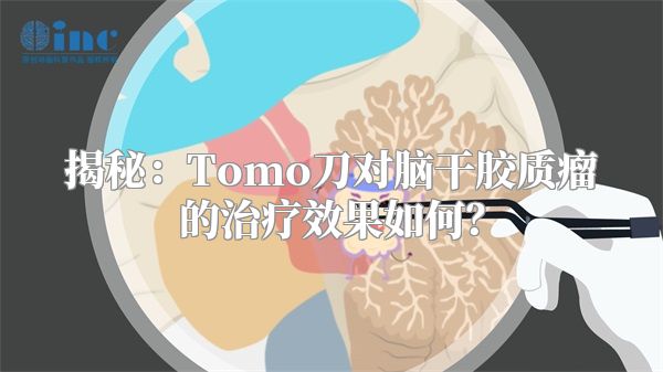 揭秘：Tomo刀对脑干胶质瘤的治疗效果如何？