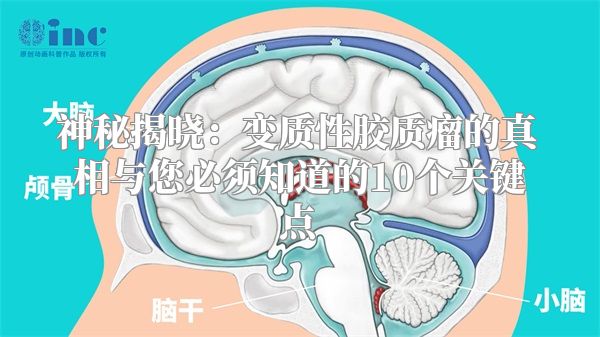 神秘揭晓：变质性胶质瘤的真相与您必须知道的10个关键点