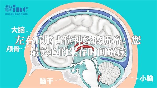 左右丘脑占位神经胶质瘤：您最关心的生存时间解读