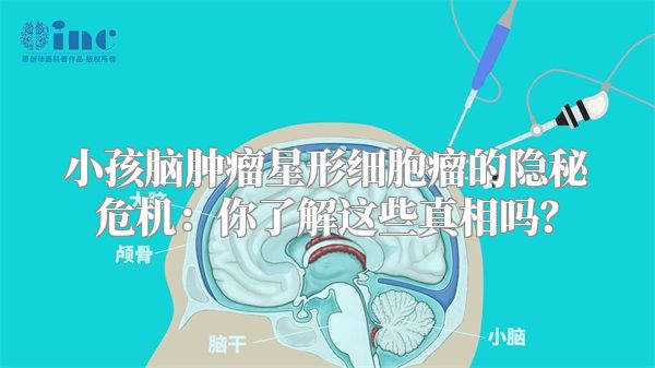 小孩脑肿瘤星形细胞瘤的隐秘危机：你了解这些真相吗？