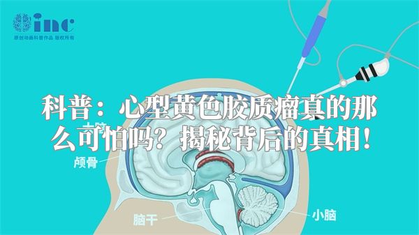 科普：心型黄色胶质瘤真的那么可怕吗？揭秘背后的真相！