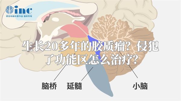 生长20多年的胶质瘤？侵犯了功能区怎么治疗？