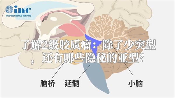 了解2级胶质瘤：除了少突型，还有哪些隐秘的亚型？