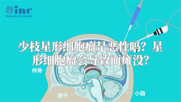 少枝星形细胞瘤是恶性吗？星形细胞瘤会导致面瘫没？