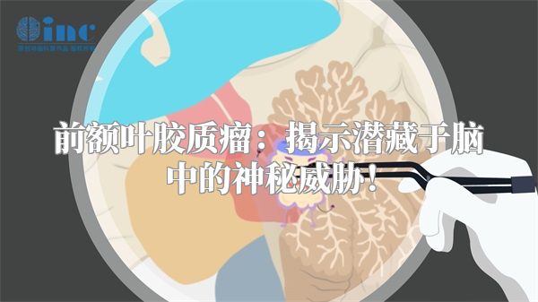 前额叶胶质瘤：揭示潜藏于脑中的神秘威胁！