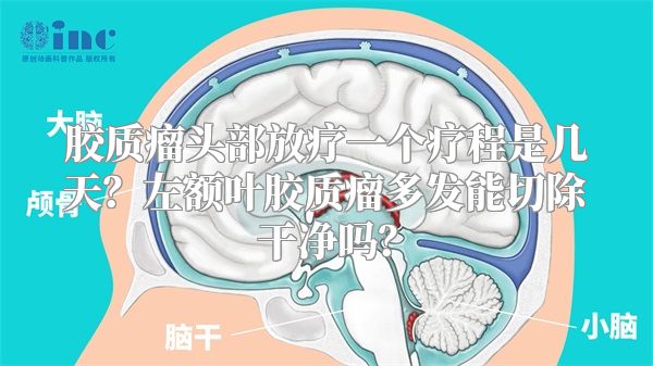 胶质瘤头部放疗一个疗程是几天？左额叶胶质瘤多发能切除干净吗？