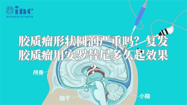 胶质瘤形状圆润严重吗？复发胶质瘤用安罗替尼多久起效果？